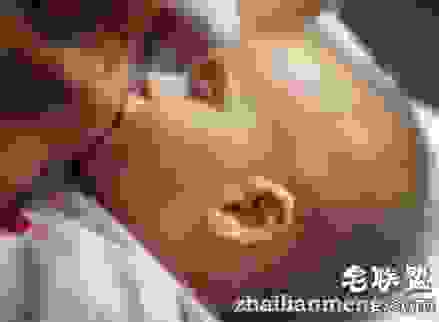 幼儿喝母乳红了眼 竟是因为妈妈吃了虾