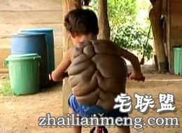哥伦比亚8岁男孩患怪病背似龟壳 半人半龟惊悚像怪兽! 哥伦比亚8岁男孩患怪病背似龟壳 半人半龟惊悚像怪兽!