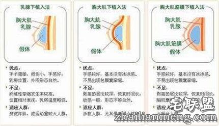 做隆胸手术安全吗?十大禁忌不可不知! 做隆胸手术安全吗?十大禁忌不可不知!