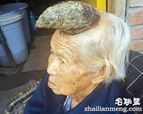 87岁老太头上长出13cm长“独角”让人称奇 87岁老太头上长出13cm长“独角”让人称奇