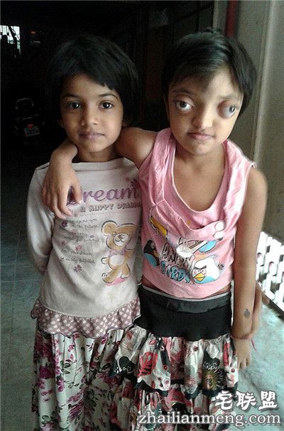 印度女孩患罕见病长”青蛙眼“ 饱受痛苦欺凌 印度女孩患罕见病长”青蛙眼“ 饱受痛苦欺凌