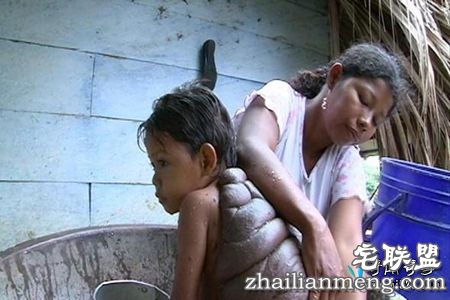 哥伦比亚8岁男孩患怪病背似龟壳 半人半龟惊悚像怪兽! 哥伦比亚8岁男孩患怪病背似龟壳 半人半龟惊悚像怪兽!