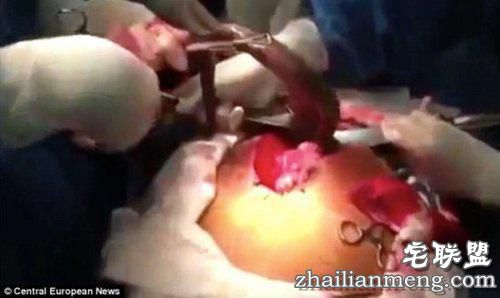 惊奇!男子体内取出一条活鱼 看到的让人全惊傻了! 惊奇!男子体内取出一条活鱼 看到的让人全惊傻了!