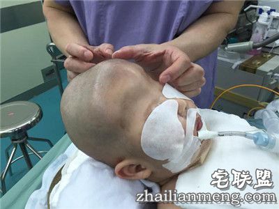 8个月男婴颅骨似外星人 网友:希望罕见疾病远离孩子们 8个月男婴颅骨似外星人 网友:希望罕见疾病远离孩子们