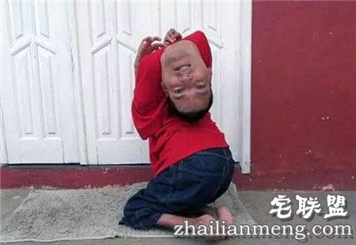 奇迹!畸形男:活着就能改变全球 奇迹!畸形男:活着就能改变全球