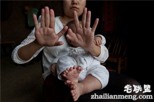 3个月大男婴患"多指症" 手指脚趾总共31根 惊呆了 3个月大男婴患"多指症" 手指脚趾总共31根 惊呆了