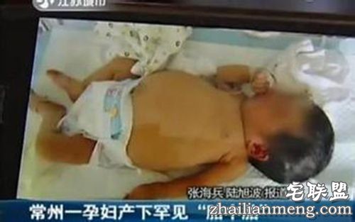 常州孕妇产下胎中胎 没想到女婴腹中还藏着胎儿! 常州孕妇产下胎中胎 没想到女婴腹中还藏着胎儿!