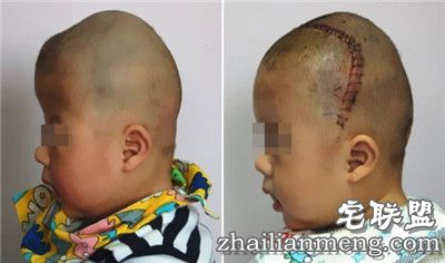8个月男婴颅骨似外星人 网友:希望罕见疾病远离孩子们 8个月男婴颅骨似外星人 网友:希望罕见疾病远离孩子们