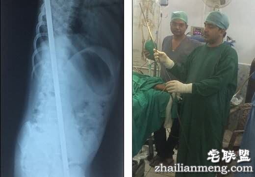 印度10岁男童被1米长钢筋贯穿,4小时手术后已无大碍! 印度10岁男童被1米长钢筋贯穿,4小时手术后已无大碍!