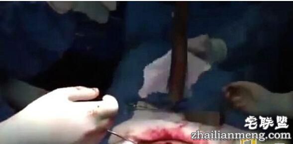 惊奇!男子体内取出一条活鱼 看到的让人全惊傻了! 惊奇!男子体内取出一条活鱼 看到的让人全惊傻了!