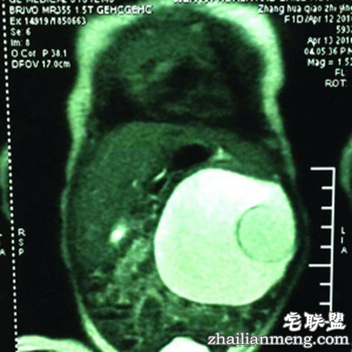 常州孕妇产下胎中胎 没想到女婴腹中还藏着胎儿! 常州孕妇产下胎中胎 没想到女婴腹中还藏着胎儿!