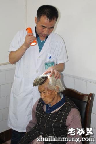 87岁老太头上长出13cm长“独角”让人称奇 87岁老太头上长出13cm长“独角”让人称奇