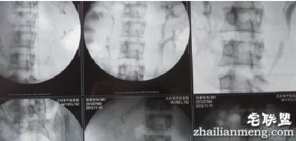 小伙长了四个肾称“并无压力” 网友:不差肾买苹果7! 小伙长了四个肾称“并无压力” 网友:不差肾买苹果7!