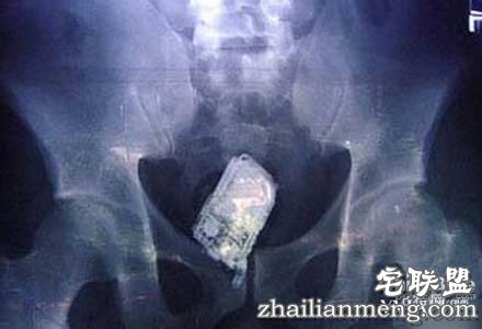 女子产后肚子震动真相曝光!竟是医生将手机落腹中! 女子产后肚子震动真相曝光!竟是医生将手机落腹中!