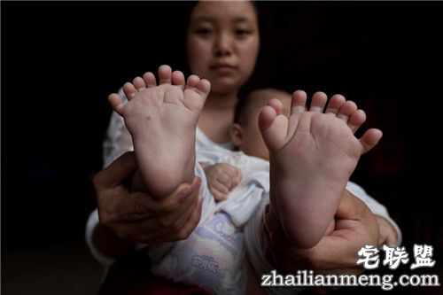 3个月大男婴患"多指症" 手指脚趾总共31根 惊呆了 3个月大男婴患"多指症" 手指脚趾总共31根 惊呆了