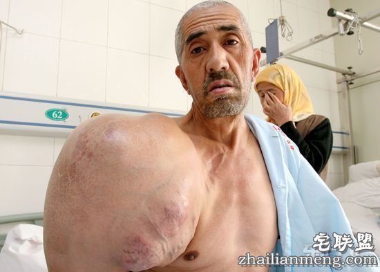 现实版!男子右肩长如绿巨人的“巨型肌肉” 现实版!男子右肩长如绿巨人的“巨型肌肉”