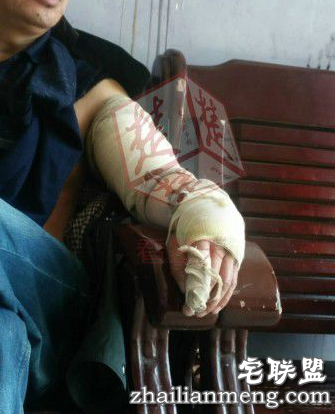 眼镜蛇被砍下蛇头瞬间弹起直咬男子 被毒蛇咬了怎么办? 眼镜蛇被砍下蛇头瞬间弹起直咬男子 被毒蛇咬了怎么办?