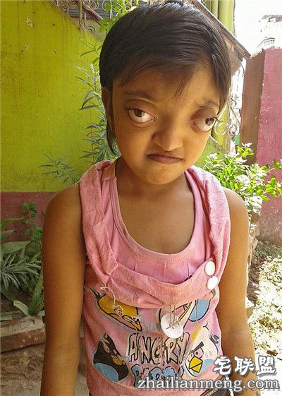 印度女孩患罕见病长”青蛙眼“ 饱受痛苦欺凌 印度女孩患罕见病长”青蛙眼“ 饱受痛苦欺凌