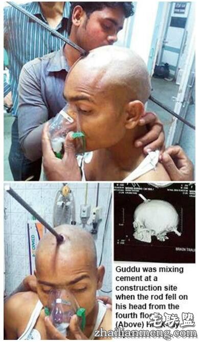 印度一男子头部被2米多长钢筋刺穿奇迹生还! 印度一男子头部被2米多长钢筋刺穿奇迹生还!