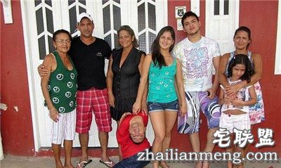 奇迹!畸形男:活着就能改变全球 奇迹!畸形男:活着就能改变全球