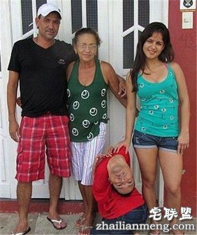 奇迹!畸形男:活着就能改变全球 奇迹!畸形男:活着就能改变全球