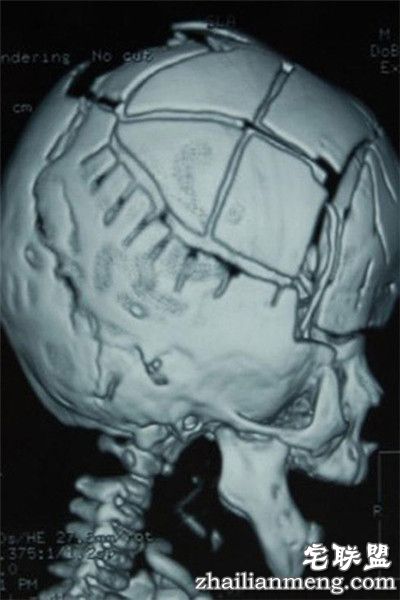 8个月男婴颅骨似外星人 网友:希望罕见疾病远离孩子们 8个月男婴颅骨似外星人 网友:希望罕见疾病远离孩子们