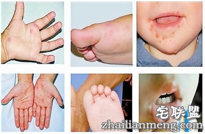 香港爆发手足口病 手足口病初期症状及预防 香港爆发手足口病 手足口病初期症状及预防