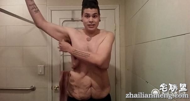 226公斤小伙猛减122公斤赘肉,但减肥成功后却不敢脱下衣服