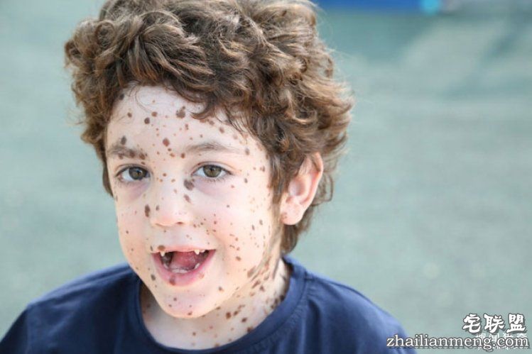 8岁男孩脸上长满胎记被嘲笑,网友的反应好有爱