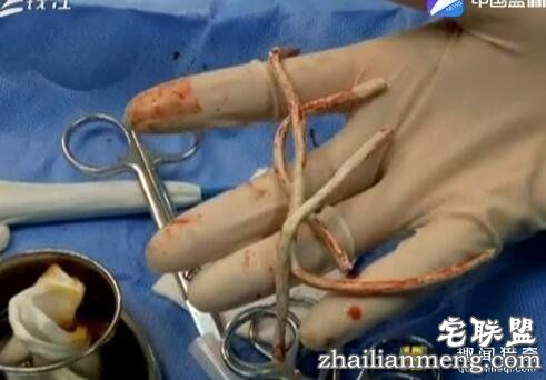 小伙看视频寻求刺激 将20cm数据线塞进尿道