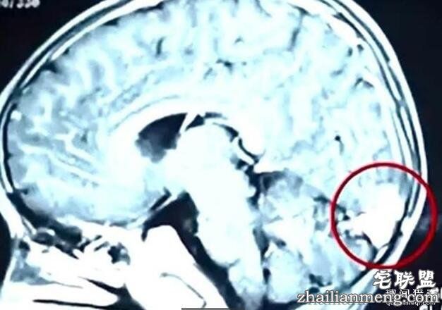 惊悚!2男童吃螃蟹 肺脑遭寄生虫吃光