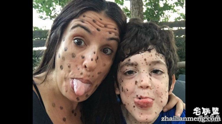 8岁男孩脸上长满胎记被嘲笑,网友的反应好有爱