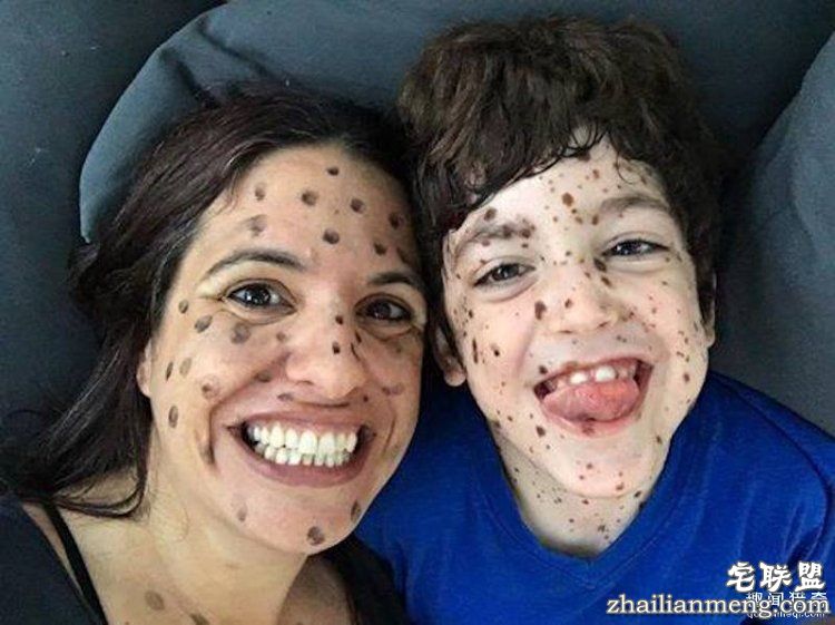 8岁男孩脸上长满胎记被嘲笑,网友的反应好有爱