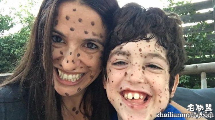 8岁男孩脸上长满胎记被嘲笑,网友的反应好有爱