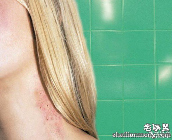 真不可思议!女友送他一个“吻痕”却要了他的命 第2张图片