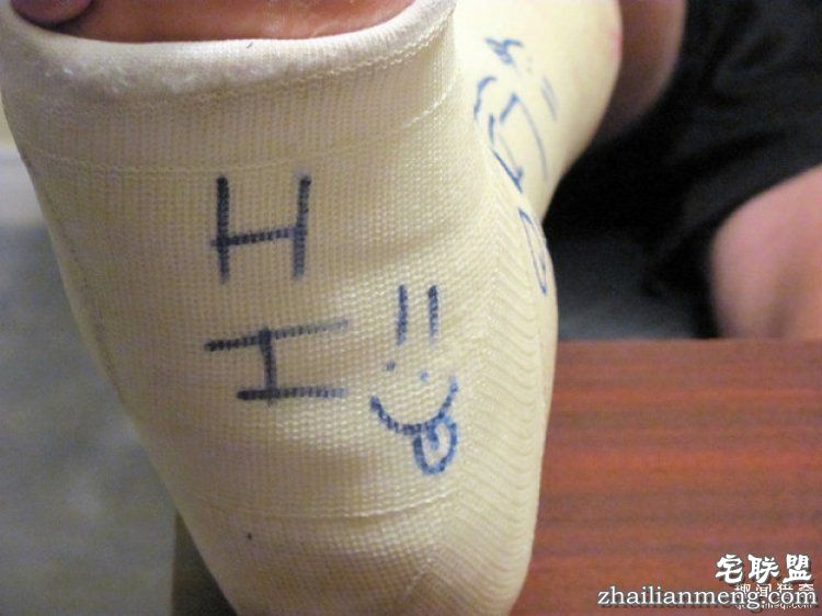 被吸尘器打断,被医生掰折…18位网友分享他们奇葩的骨折原因