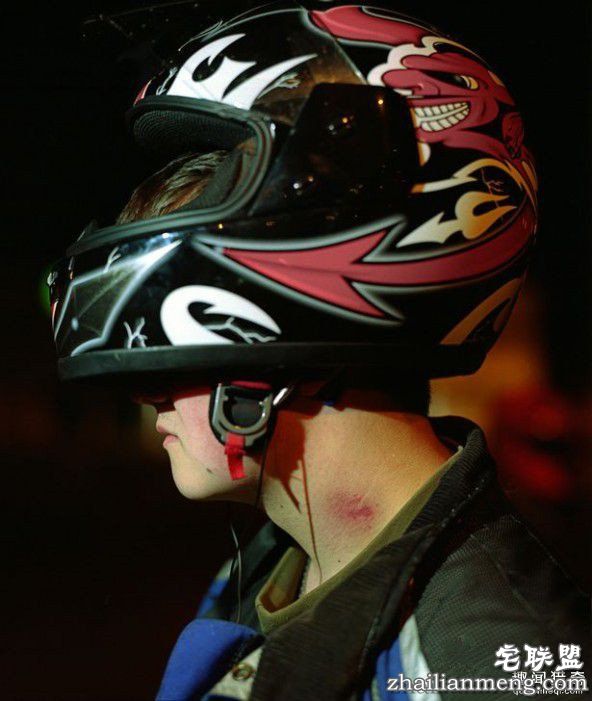 真不可思议!女友送他一个“吻痕”却要了他的命 第1张图片