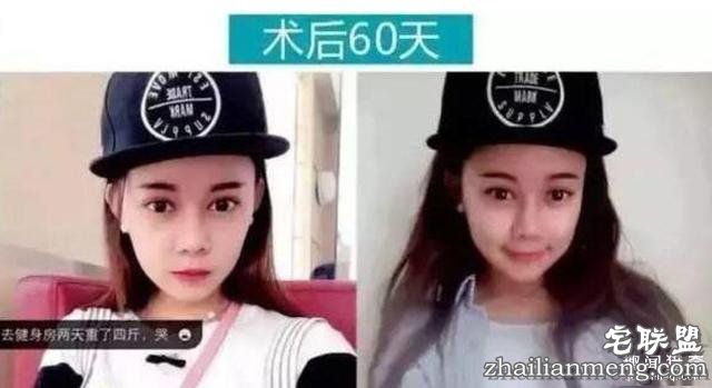 女孩花百万变身“重庆版Angelababy”,整容前后对比,惊呆了!!!
