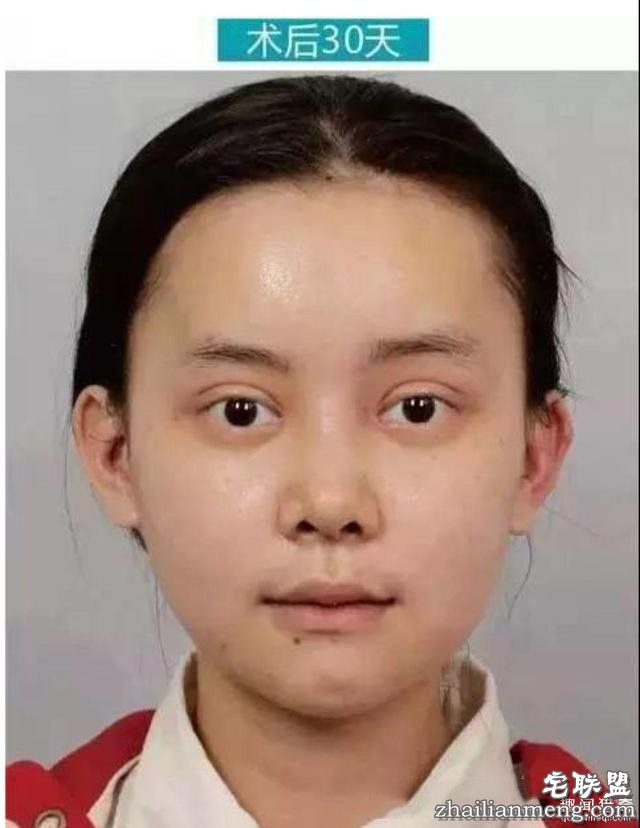 女孩花百万变身“重庆版Angelababy”,整容前后对比,惊呆了!!!