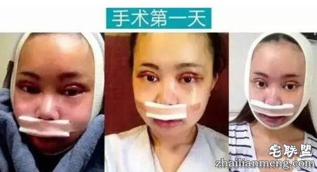 女孩花百万变身“重庆版Angelababy”,整容前后对比,惊呆了!!!
