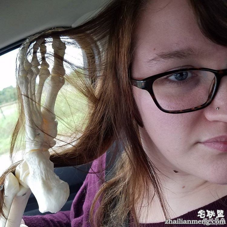 女孩被截肢后,天天拿着自己的脚骨自拍