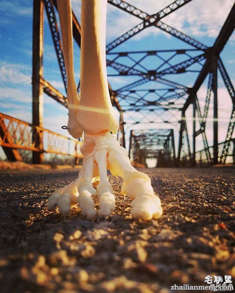 女孩被截肢后,天天拿着自己的脚骨自拍