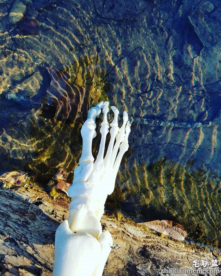 女孩被截肢后,天天拿着自己的脚骨自拍