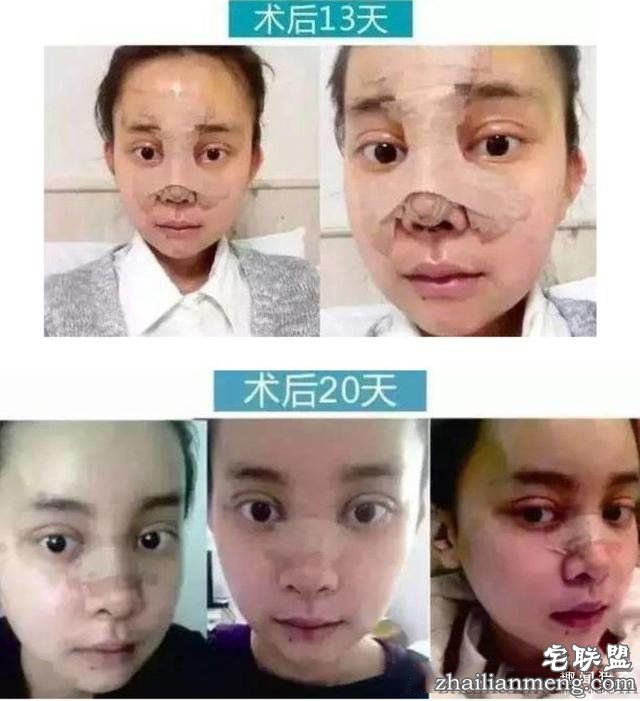女孩花百万变身“重庆版Angelababy”,整容前后对比,惊呆了!!!