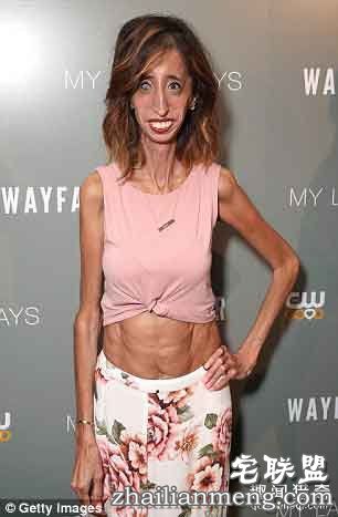 丽兹(Lizzie Velasquez)
