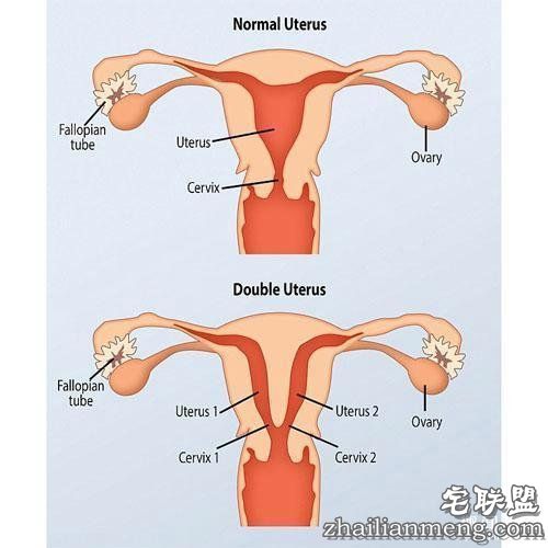 英国女子多年不孕,原来是双阴道双子宫,夫妻俩没找对地方
