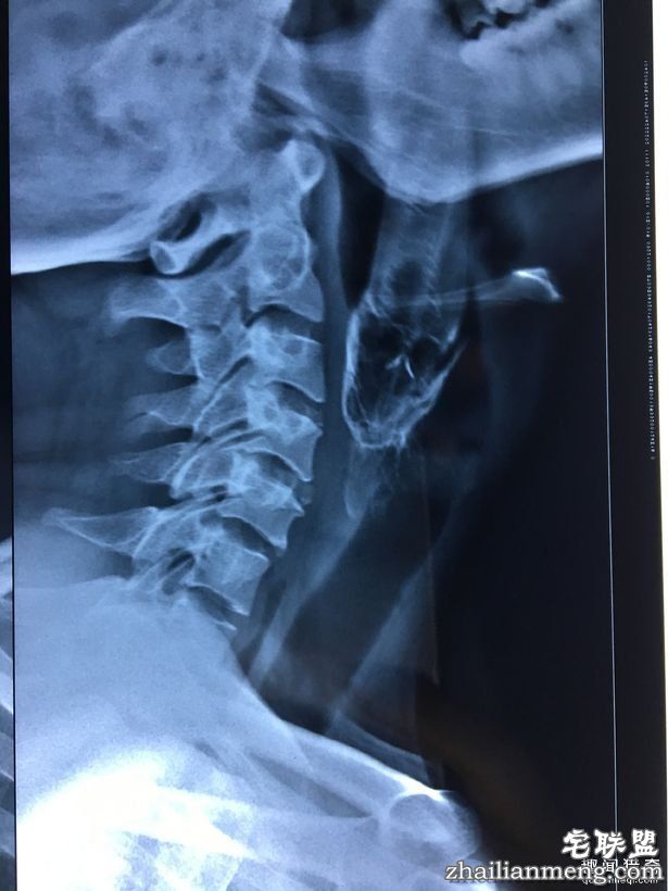 男子「活鱼卡喉咙」痛苦快死,医生「拉出整条画面」大傻眼!