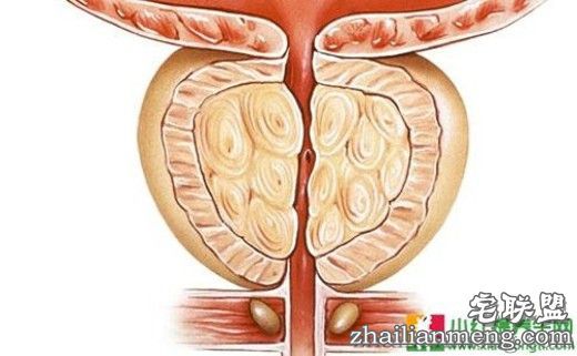 性生活过长小心前列腺炎 怎么样才算包皮过长