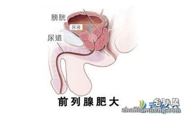 青年男性得了前列腺增生有什么特点