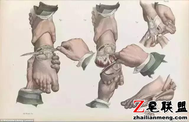 西方外科黑历史,理发师垄断手术只会放血,医生掘墓解剖练手速